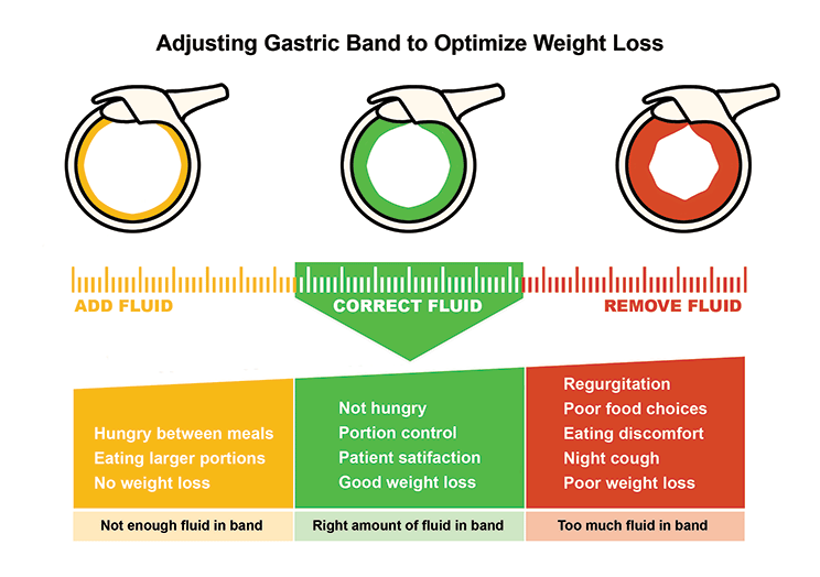 Lap Band Adjustment Zones