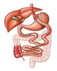 Gastric Bypass